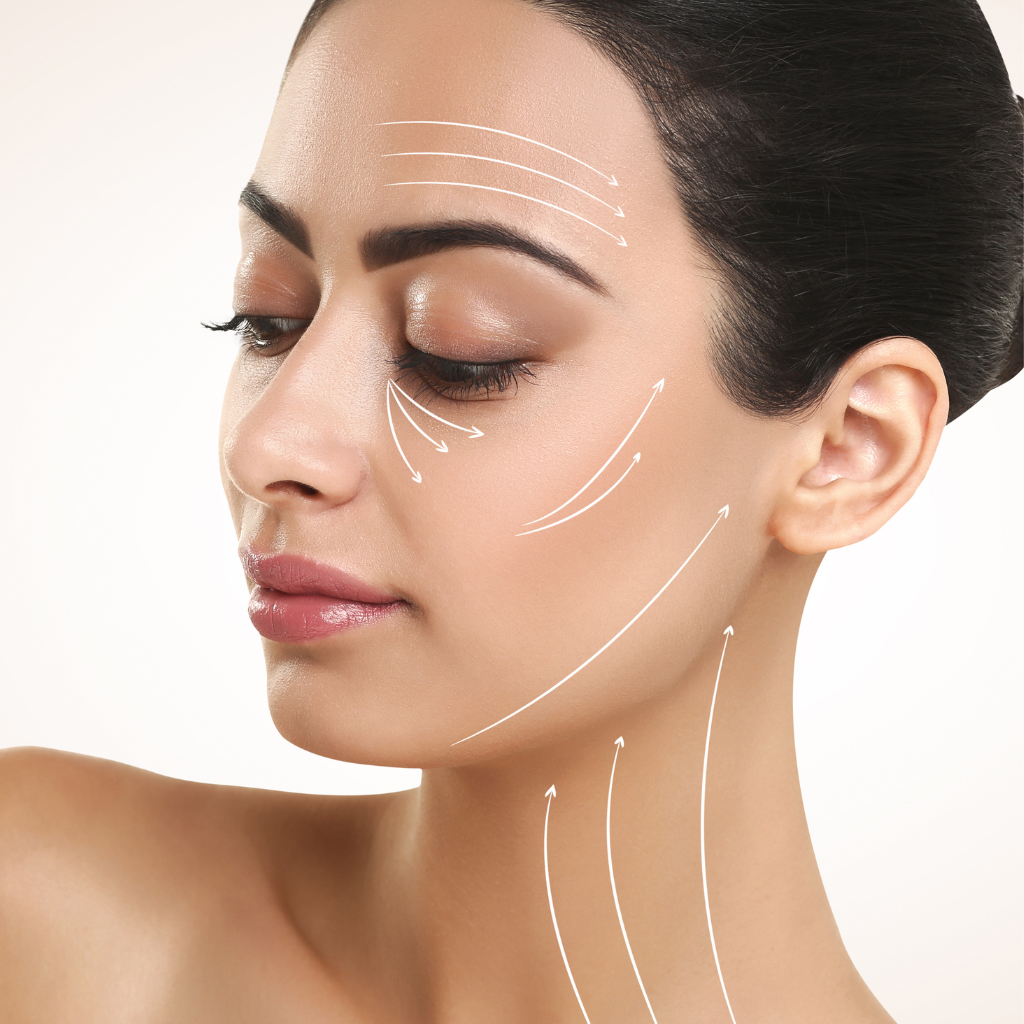 Illustration des zones d’insertion et de traction des fils tenseurs pour un effet liftant naturel, enseignées en formation esthétique professionnelle.